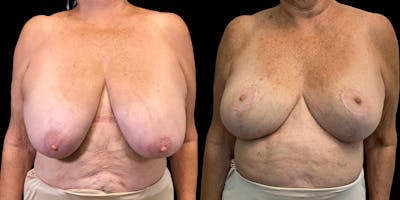Breast Reduction Gallery - Patient 53828628 - Image 1