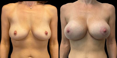 Breast Lift Before & After Gallery - Patient 180901 - Image 1