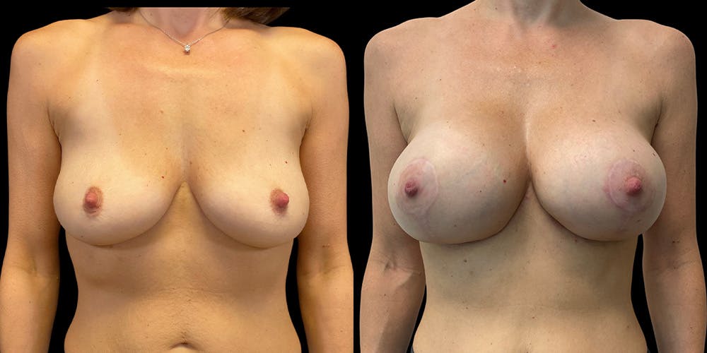 Breast Lift with Implants Gallery - Patient 53830040 - Image 1