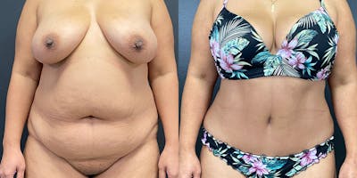 Tummy Tuck Before & After Gallery - Patient 54674548 - Image 1