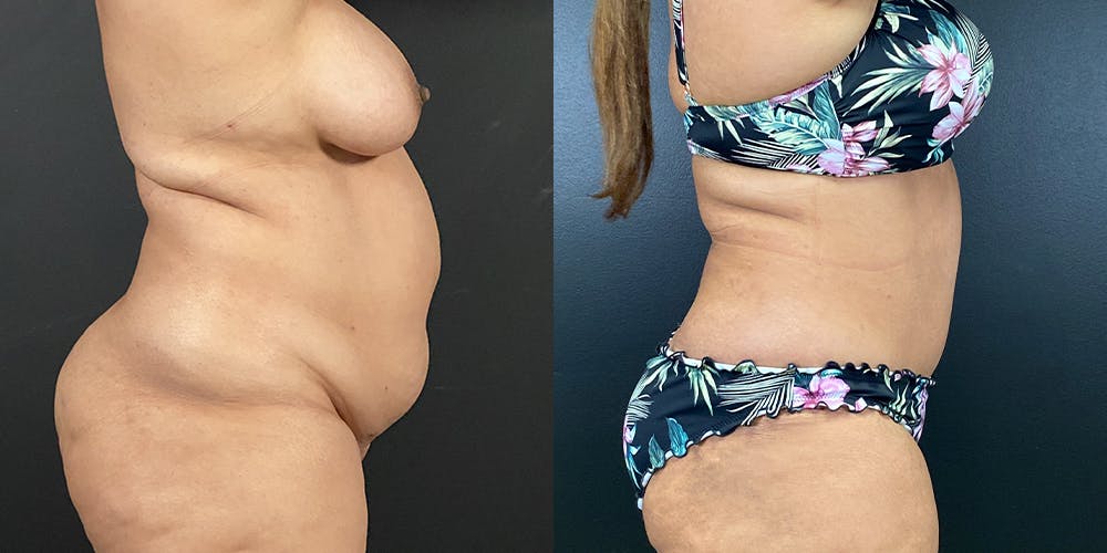 Tummy Tuck Before & After Gallery - Patient 54674548 - Image 2