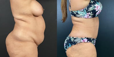 Tummy Tuck Before & After Gallery - Patient 54674548 - Image 2