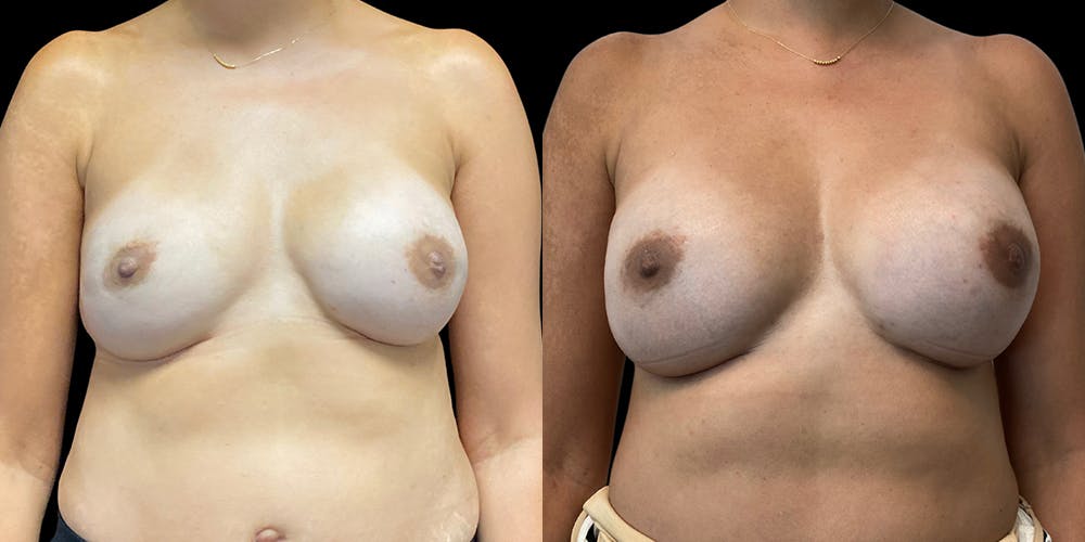Breast Reconstruction Before & After Gallery - Patient 54674691 - Image 1