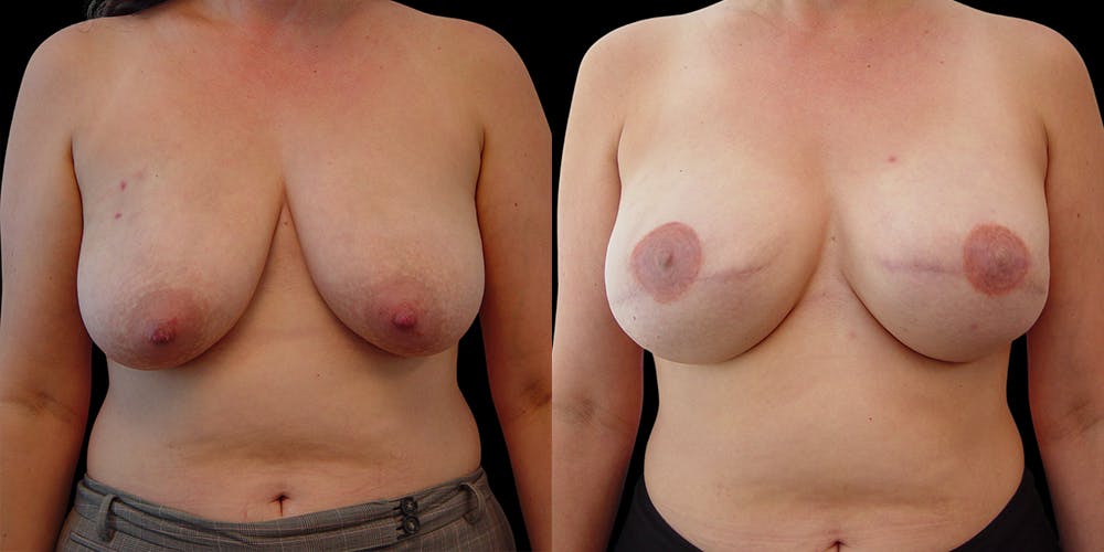 Breast Reconstruction Before & After Gallery - Patient 54674692 - Image 1