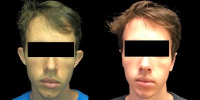 Otoplasty Before & After Gallery - Patient 54869384 - Image 1