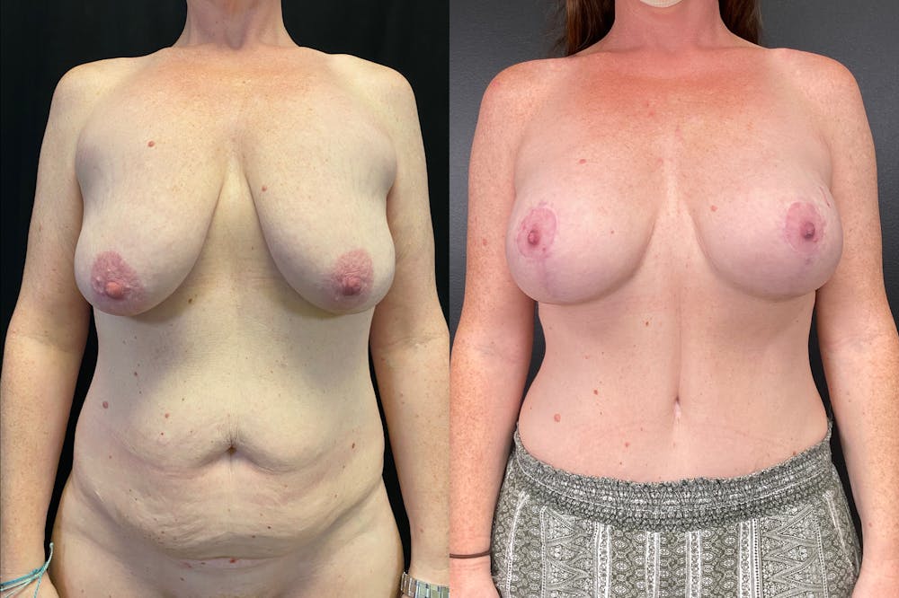 Mommy Makeover Before & After Gallery - Patient 54869397 - Image 1