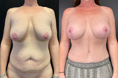 Mommy Makeover Before & After Gallery - Patient 54869397 - Image 1