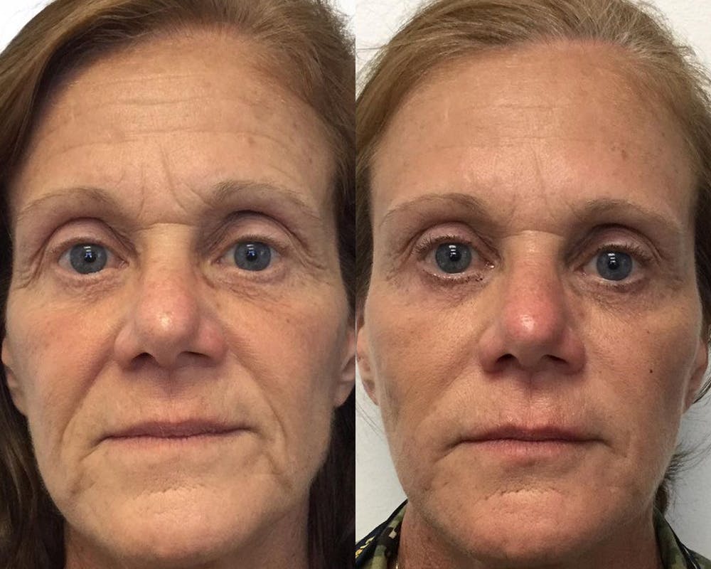 Botox Before & After Gallery - Patient 54877566 - Image 1