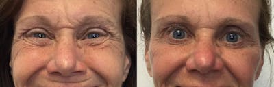 Botox Before & After Gallery - Patient 54877566 - Image 2