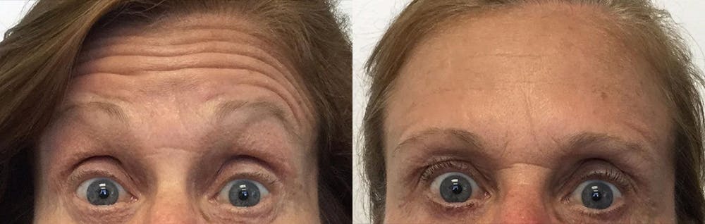 Botox Before & After Gallery - Patient 54877566 - Image 3