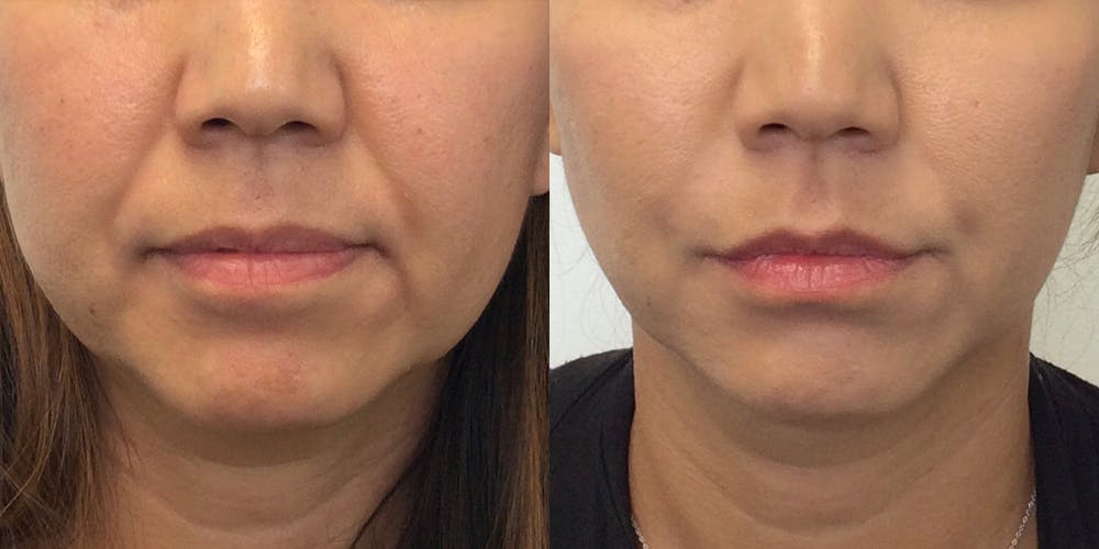 Dermal Fillers Before & After Gallery - Patient 54877569 - Image 1