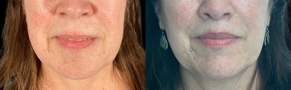 Buccal Fat Removal Before & After Gallery - Patient 55029163 - Image 1