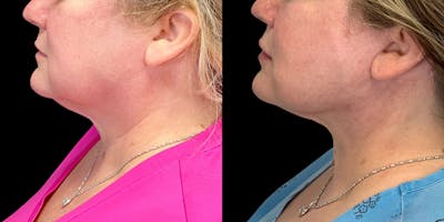 Facelift Before & After Gallery - Patient 55029172 - Image 2