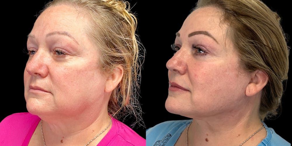 Necklift Before & After Gallery - Patient 55029175 - Image 2