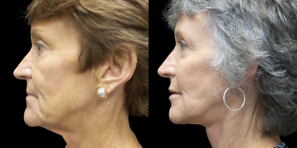 Facelift Before & After Gallery - Patient 55029173 - Image 2
