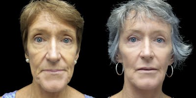Facelift Before & After Gallery - Patient 55029173 - Image 1