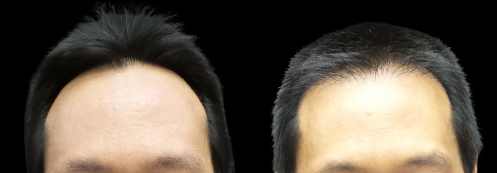 Hair Restoration Before & After Gallery - Patient 55029204 - Image 1