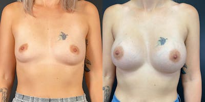 Breast Augmentation Gallery - Patient 55272483 - Image 1