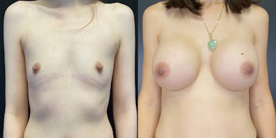 Breast Augmentation Before & After Gallery - Patient 55272484 - Image 1