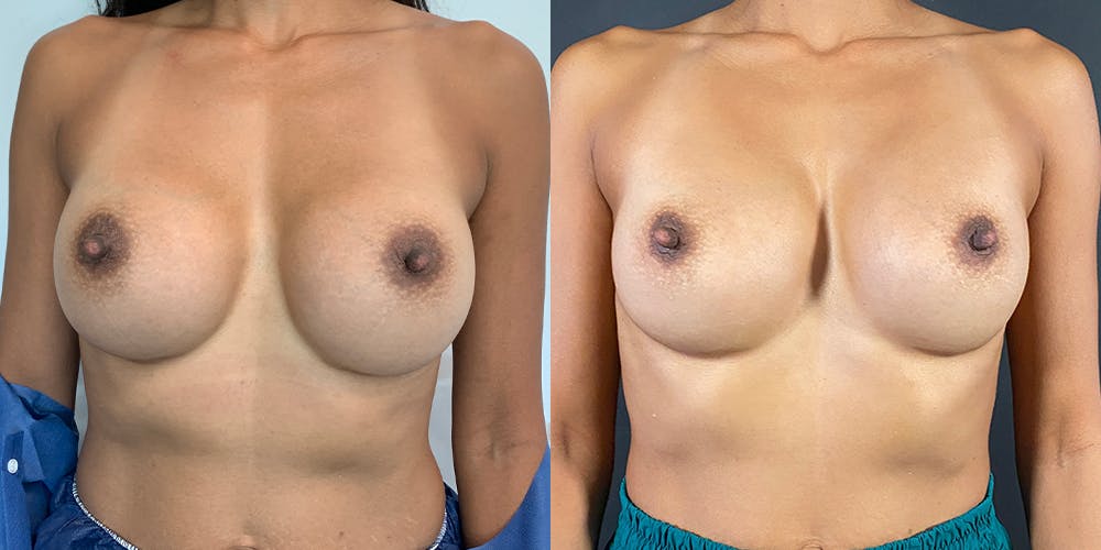 Breast Augmentation Revision Before & After Gallery - Patient 56142674 - Image 1