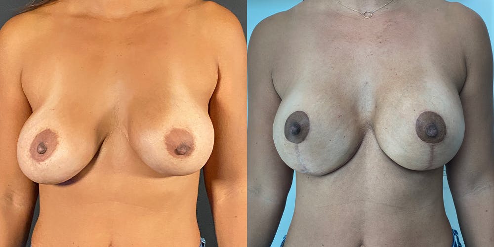 Breast Augmentation Revision Before & After Gallery - Patient 56142676 - Image 1