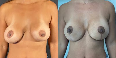 Breast Augmentation Revision Before & After Gallery - Patient 56142676 - Image 1