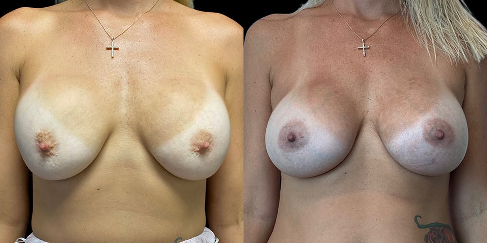 Breast Augmentation Revision Before & After Gallery - Patient 56143247 - Image 1