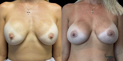 Breast Augmentation Revision Before & After Gallery - Patient 56143247 - Image 1