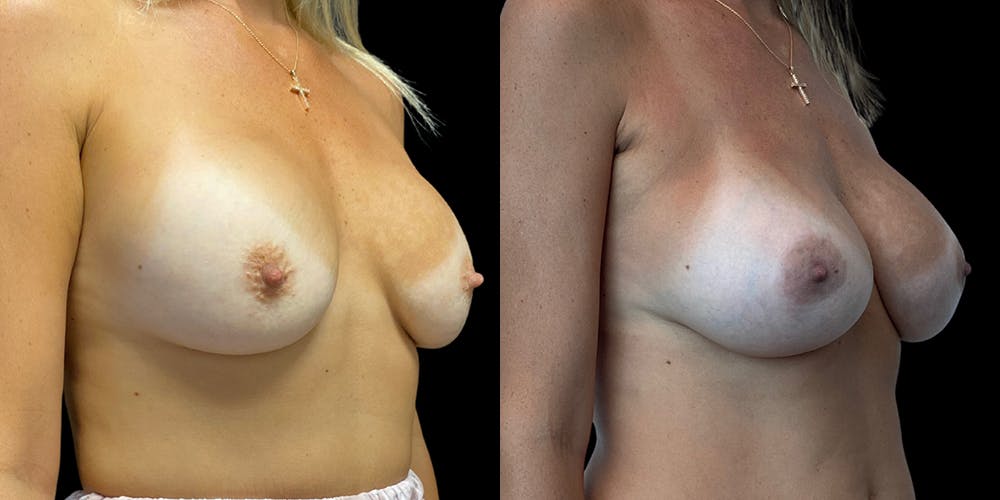 Breast Augmentation Revision Before & After Gallery - Patient 56143247 - Image 2
