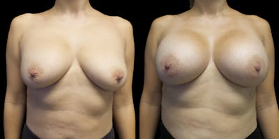 Breast Augmentation Revision Before & After Gallery - Patient 56175578 - Image 1