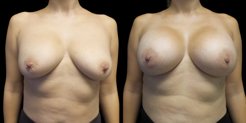 Breast Augmentation Revision Gallery - Patient 56175578 - Image 1