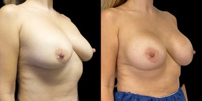 Breast Augmentation Revision Before & After Gallery - Patient 56175578 - Image 2
