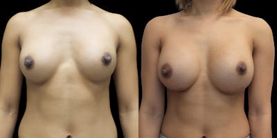 Breast Augmentation Revision Before & After Gallery - Patient 56175579 - Image 1