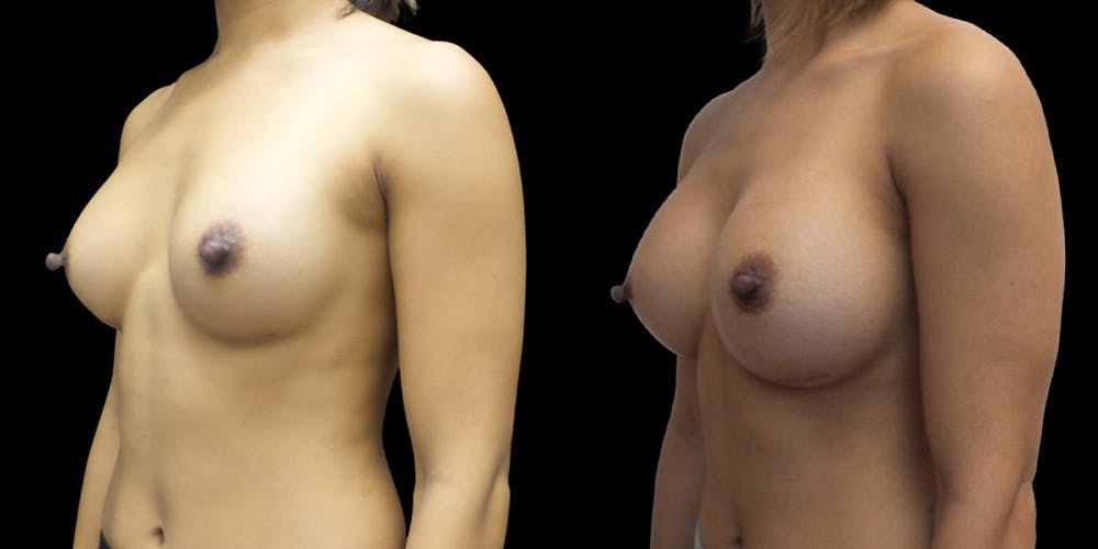 Breast Augmentation Revision Before & After Gallery - Patient 56175579 - Image 2