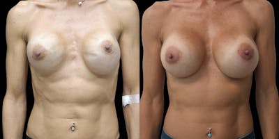 Breast Augmentation Revision Before & After Gallery - Patient 56175972 - Image 1