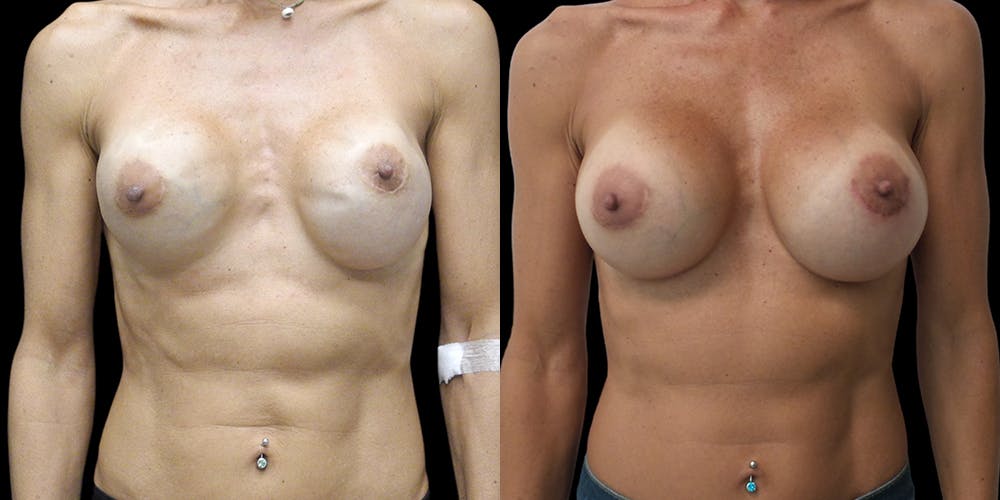 Breast Augmentation Revision Gallery - Patient 56175972 - Image 1