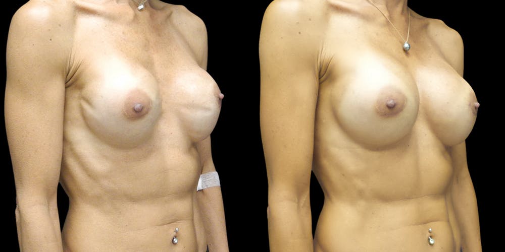 Breast Augmentation Revision Before & After Gallery - Patient 56175972 - Image 2