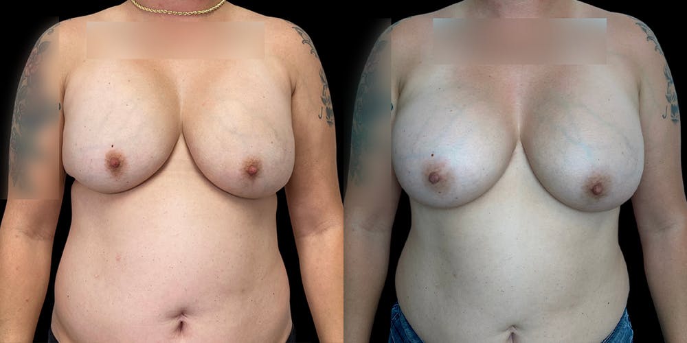 Breast Augmentation Revision Before & After Gallery - Patient 56175973 - Image 1