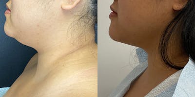 Laser Liposuction Before & After Gallery - Patient 71703804 - Image 1