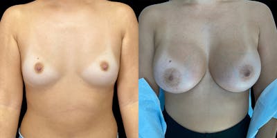 Breast Augmentation Before & After Gallery - Patient 113523787 - Image 1
