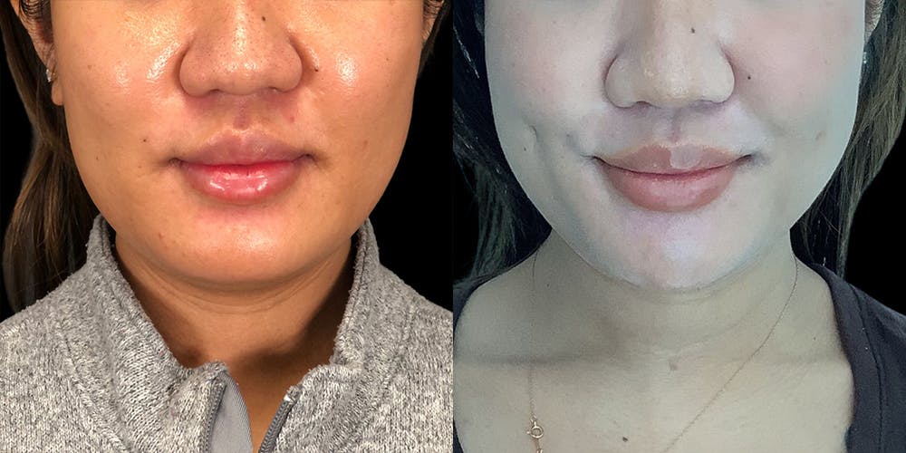 Dimpleplasty Before & After Gallery - Patient 113523856 - Image 1