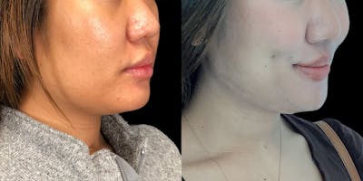 Dimpleplasty Before & After Gallery - Patient 113523856 - Image 2