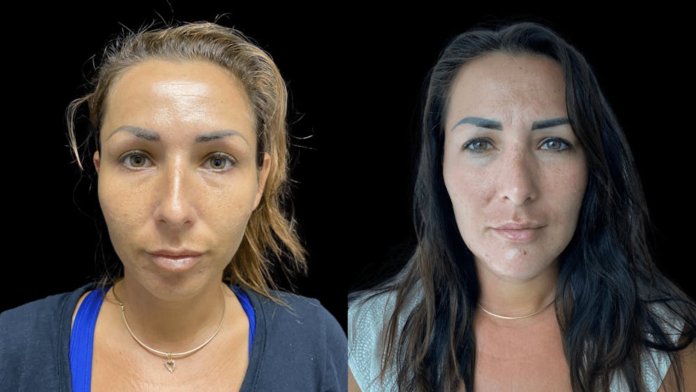 Rhinoplasty Before & After Gallery - Patient 54674571 - Image 2