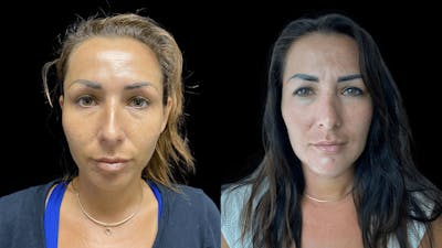 Rhinoplasty Before & After Gallery - Patient 54674571 - Image 2