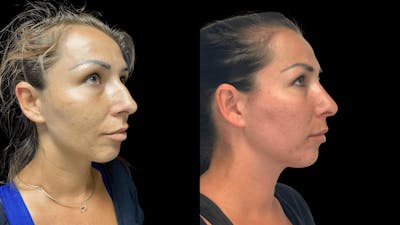 Rhinoplasty Before & After Gallery - Patient 54674571 - Image 1