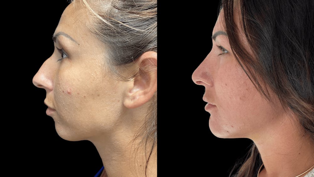 Rhinoplasty Before & After Gallery - Patient 54674571 - Image 3
