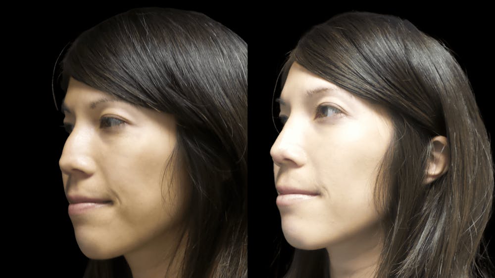 Rhinoplasty Before & After Gallery - Patient 295810 - Image 2