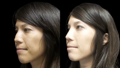 Rhinoplasty Before & After Gallery - Patient 120354283 - Image 2