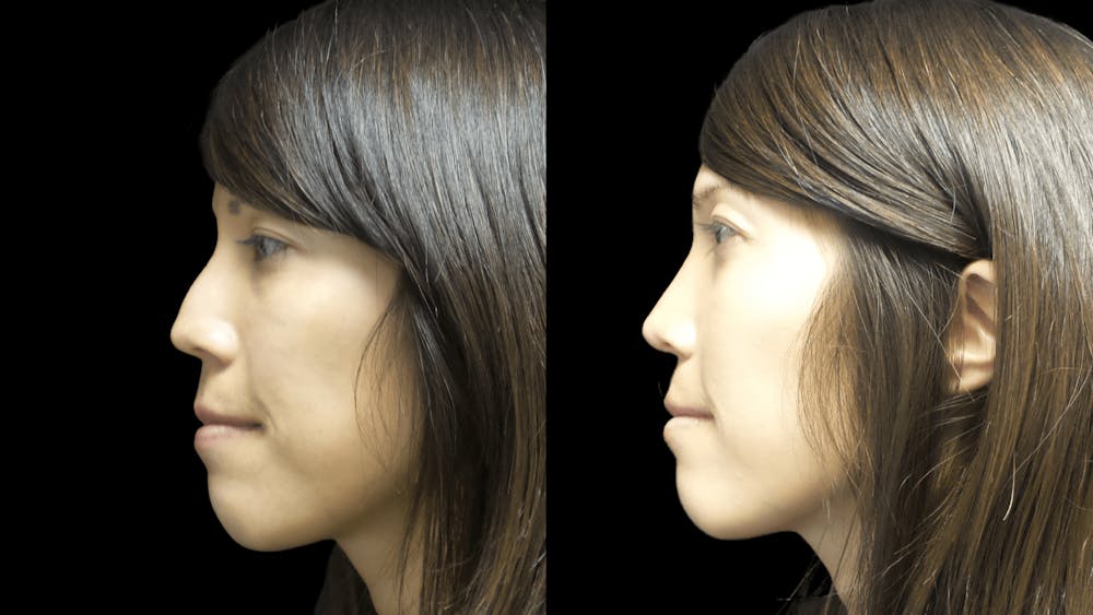 Rhinoplasty Before & After Gallery - Patient 120354283 - Image 3