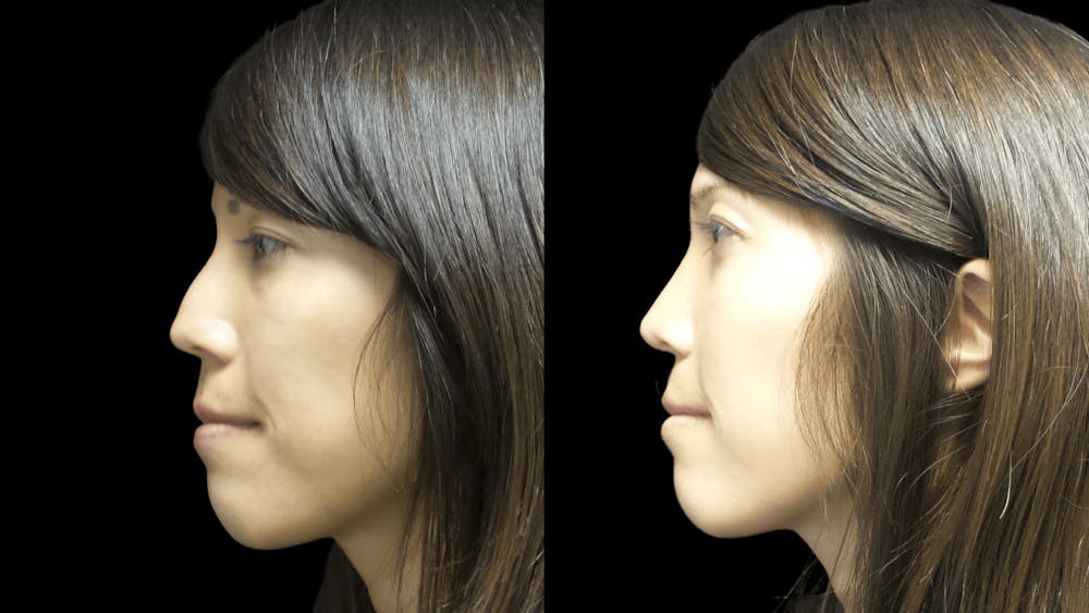 Rhinoplasty Before & After Gallery - Patient 295810 - Image 3